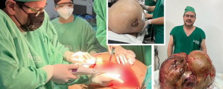 خارج کردن تومور ۴۵ کیلویی از شکم زنی که نمی‌توانست نفس بکشد و راه برود