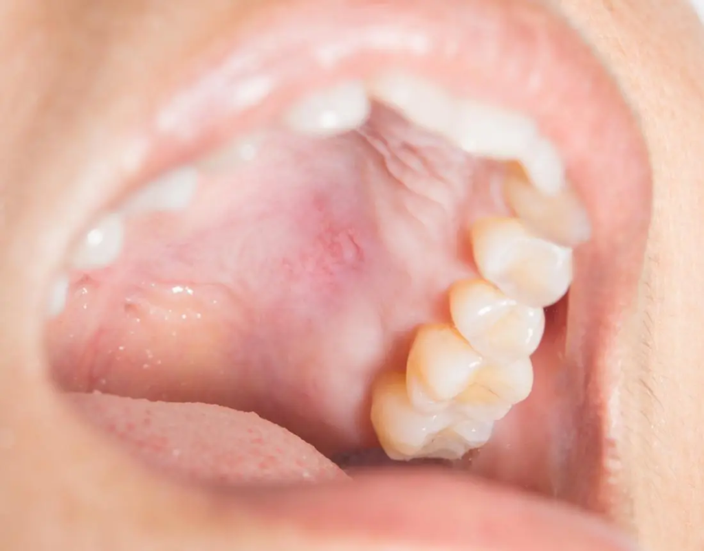 علت زخم شدن داخل دهان چیست و چطور درمان می‌شود؟