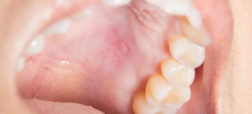 علت زخم شدن داخل دهان چیست و چطور درمان می‌شود؟