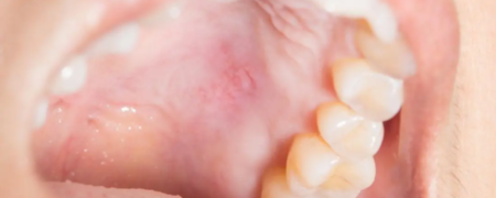 علت زخم شدن داخل دهان چیست و چطور درمان می‌شود؟