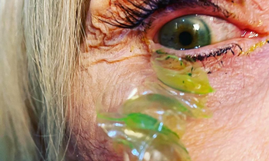 خارج کردن ۲۳ لنز چشم جامانده از چشمان یک زن ۷۰ ساله پس از دو سال + ویدیو