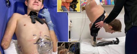 داستان زندگی نوجوانی که نیمی از بدنش توسط یک لیفتراک له شد + ویدیو