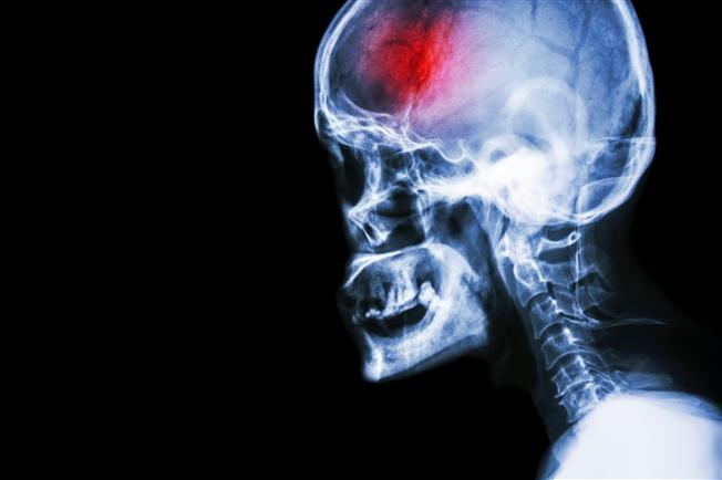 علائم ضربه مغزی چیست؟
