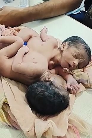 تولد دوقلوهای اعجاب انگیزی که از قفسه سینه به هم چسبیده‌اند