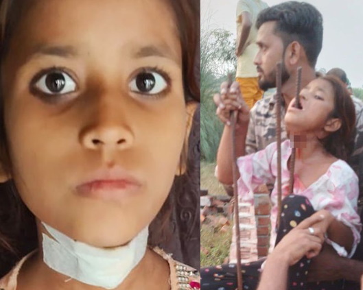 نجات معجزه آسای دختر ۸ ساله هندی پس از عبور میله فلزی از گردن و خروج آن از دهانش