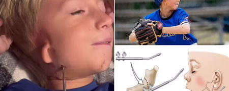 پسر ۱۰ ساله با نقص مادرزادی نادر که هر روز باید استخوان فک خود را پیچ کند + ویدیو