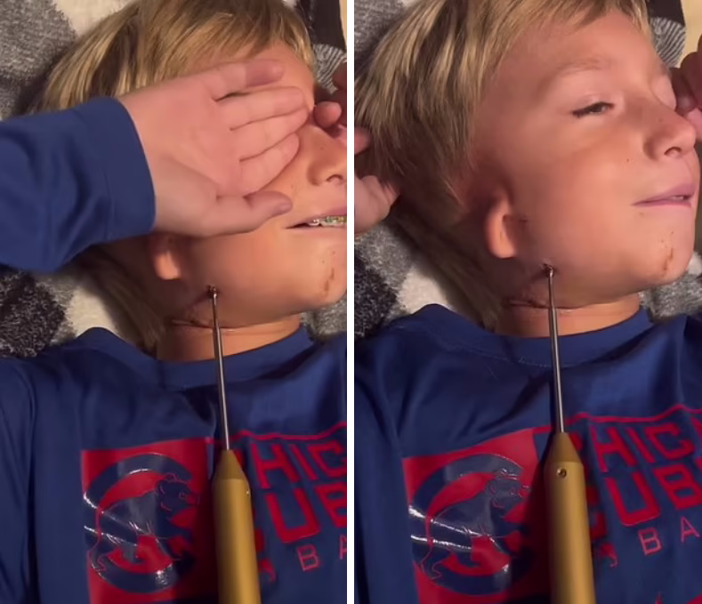 کودک مبتلا به بیماری نادر که هر روز باید فک خود را پیچ کند + ویدیو