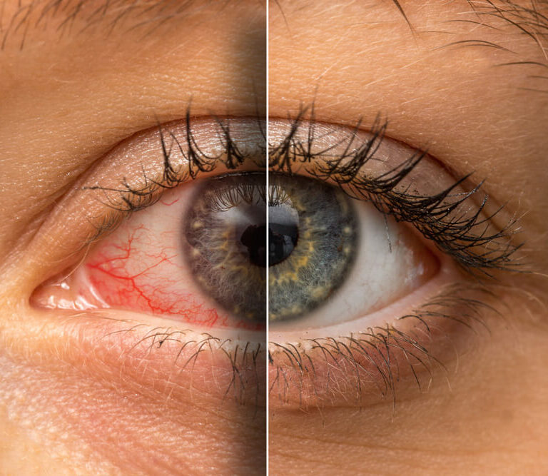 ۵ علت رایج قرمزی چشم و راه‌های درمان آن 