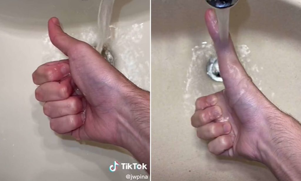 جوانی که می تواند اندازه انگشت شست خود را تغییر دهد در تیک تاک معروف شد + ویدیو