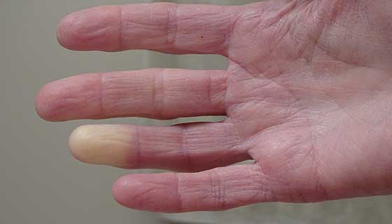 علائم بیماری که در دست ها دیده می شوند چیست؟