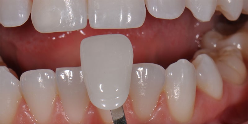 لمینت دندان به چه روش هایی انجام می‌شود و مزایا و معیاب روش های لمینت دندان چیست؟