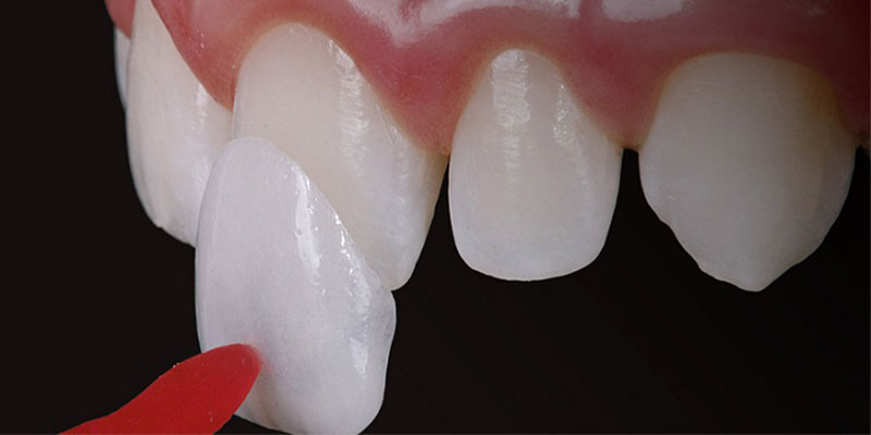لمینت دندان به چه روش هایی انجام می‌شود و مزایا و معیاب روش های لمینت دندان چیست؟