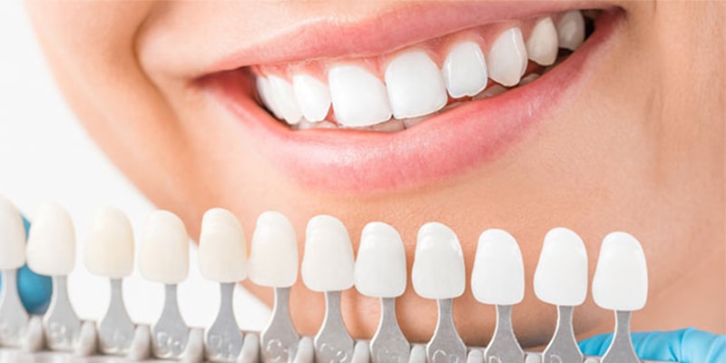 مزایا و معایب انواع روش های لمینت دندان