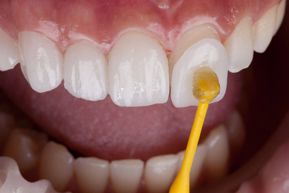 سرامیک دندانی چیست؟