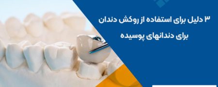 ۳ دلیل برای استفاده از روکش برای دندانهای پوسیده