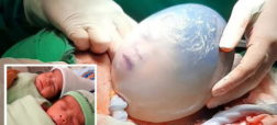 اتفاق نادر تولد یک نوزاد در حالی که کیسه آب هنوز کاملاً سالم است