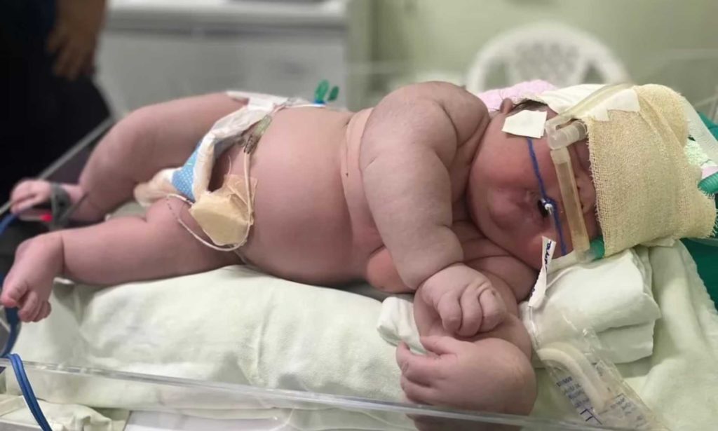 نوزادی ۷ کیلوگرمی با ۶۰ سانتیمتر قد از طریق سزارین در برزیل به دنیا آمد