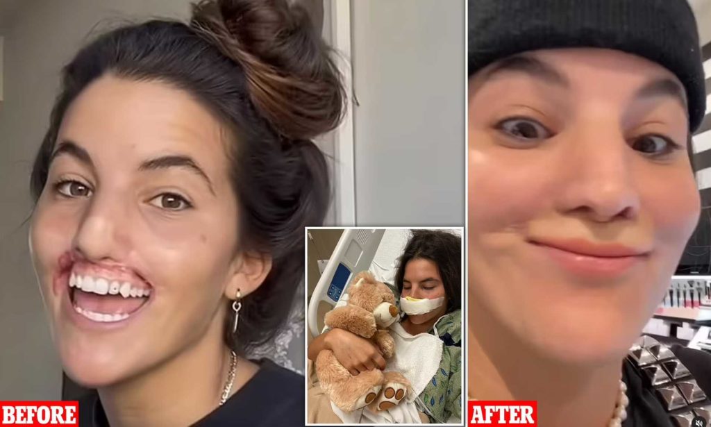 لبخند دوباره مدل جوانی که لبش توسط سگ پیت بول کنده شد، پس از عمل جراحی + ویدیو