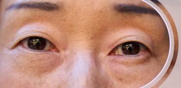 از سیاهی زیر چشم تا خطوط پنجه کلاغی؛ بهترین روش ها برای درمان چروک های دور چشم