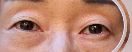 از سیاهی زیر چشم تا خطوط پنجه کلاغی؛ بهترین روش ها برای درمان چروک های دور چشم