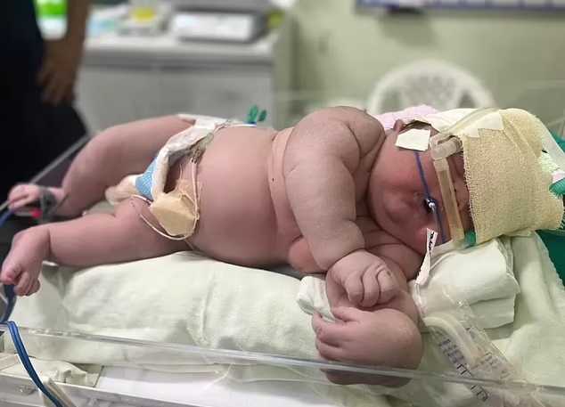 نوزاد بزرگی که در برزیل به دنیا آمد