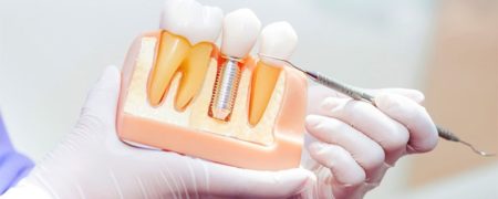 ایمپلنت اقساطی دندان با بهترین مواد و متخصص در شهریار