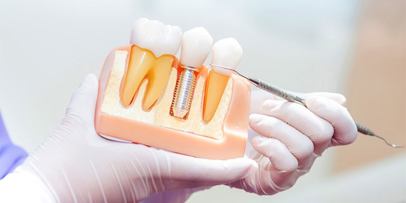 ایمپلنت اقساطی دندان با بهترین مواد و متخصص در شهریار