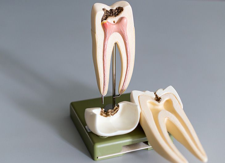 هرآنچه باید درباره عصب کشی دندان بدانید