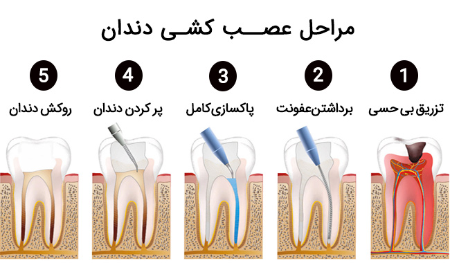 هرآنچه باید درباره عصب کشی دندان بدانید