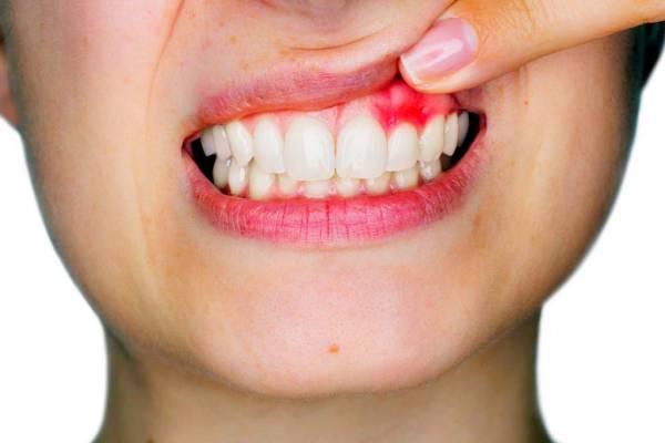 کیست دندان چیست و چگونه درمان می‌شود؟