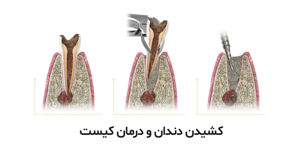 کیست دندان چیست و چگونه درمان می‌شود؟