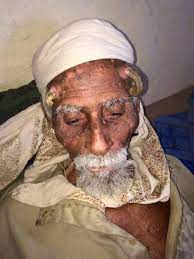 مرد ۱۴۰ ساله یمنی که دو شاخ روی پیشانی اش دارد