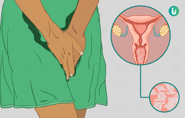 عفونت قارچی واژن؛ از علت بروز تا پیشگیری و درمان