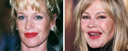 تغییر چهره ۱۲ فرد مشهور پس از جراحی پلاستیک