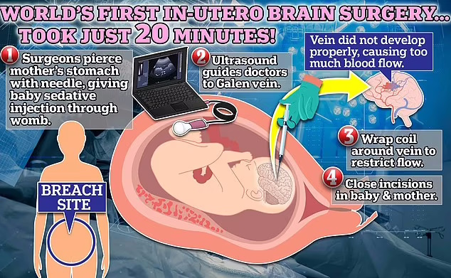 اولین جراحی مغز جهان روی یک نوزاد متولد نشده 