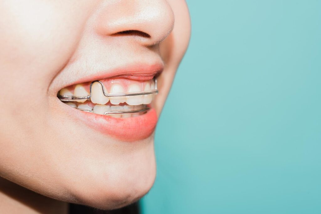 ارتودنسی دندان با اقساط بلند مدت در تابستان 1402
