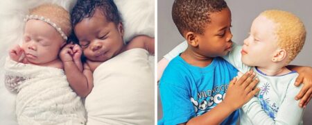 ماجرای عجیب مادری که بعد از ۱۰ سال نازایی صاحب دوقلوی سیاهپوست و سفیدپوست شد