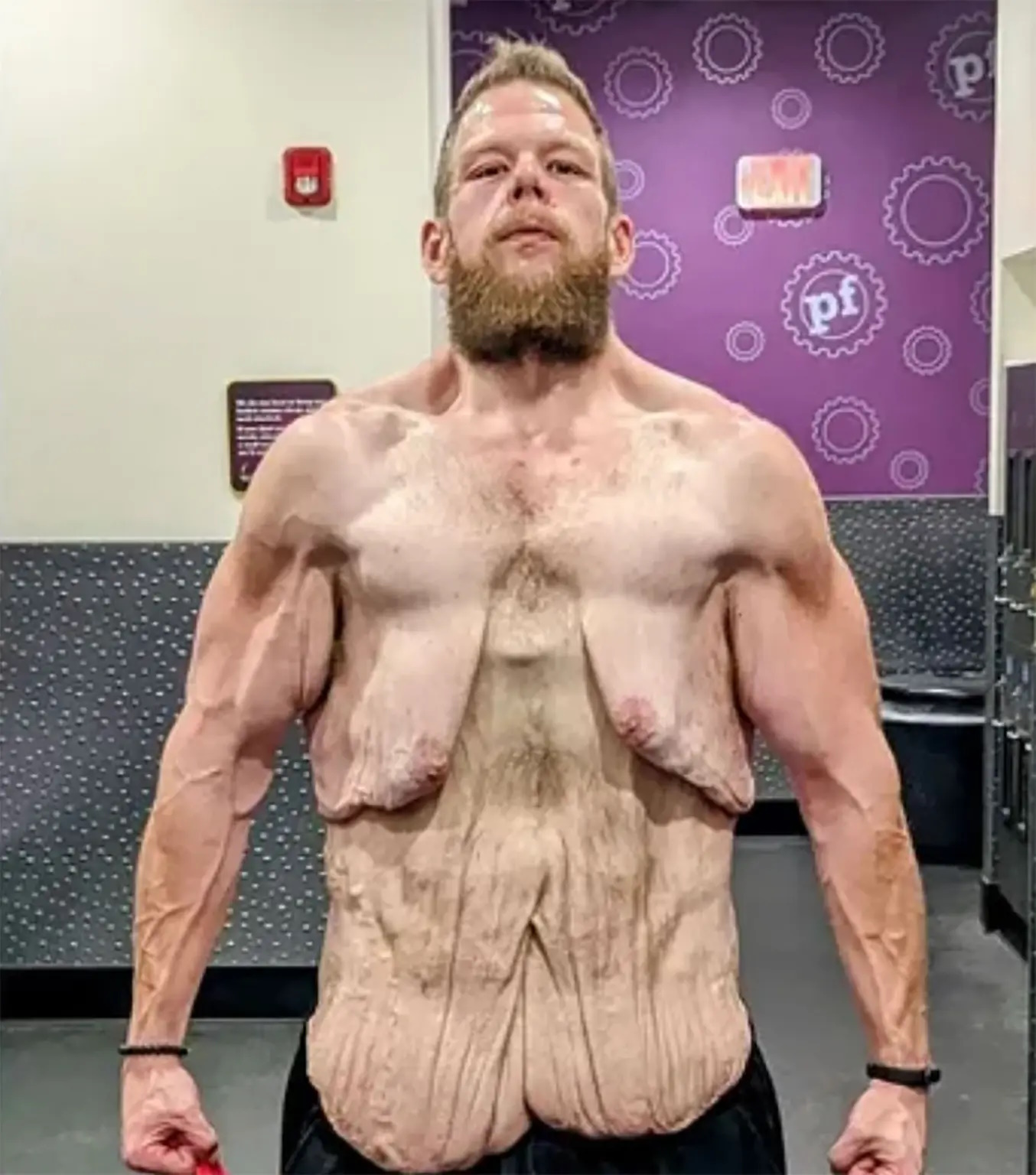 کاهش وزن ۱۶۰ کیلوگرمی این مرد و پوست اضافه ای که نیاز به ۵ عمل جراحی دارد