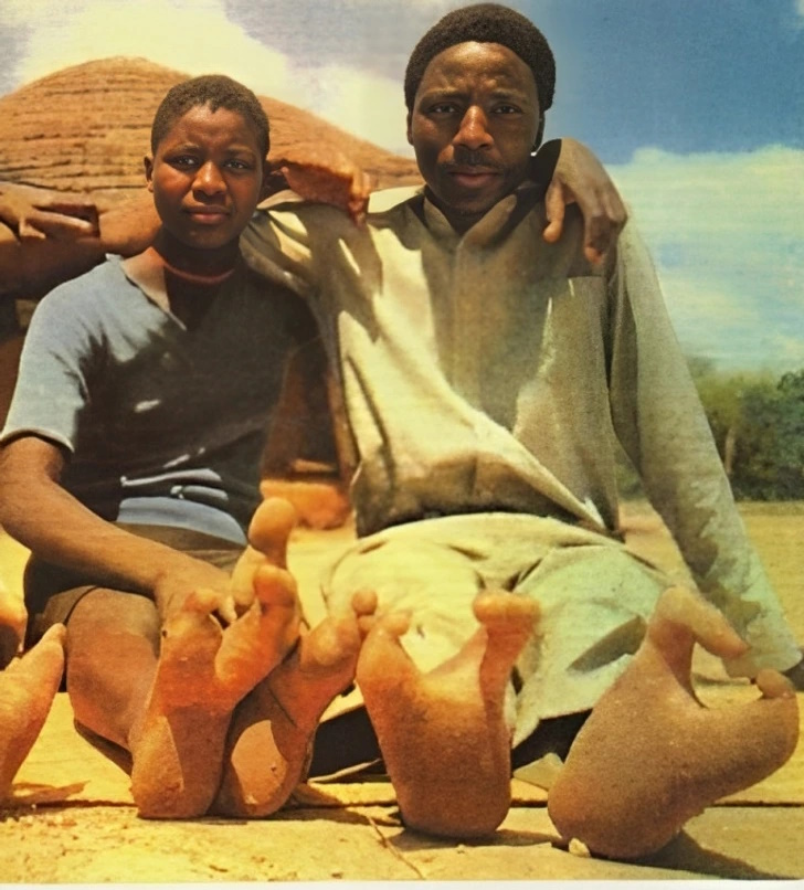 قبیله آفریقایی که مردم آن فقط دو انگشت در هر پا دارند