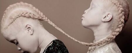 ظاهر آلبینوها یا زال ها در نژادهای مختلف چه فرقی می کنند؟