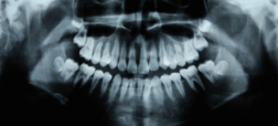 امکان رویش دندان های تازه در انسان ها با ابداع دارویی جدید تا سال ۲۰۳۰