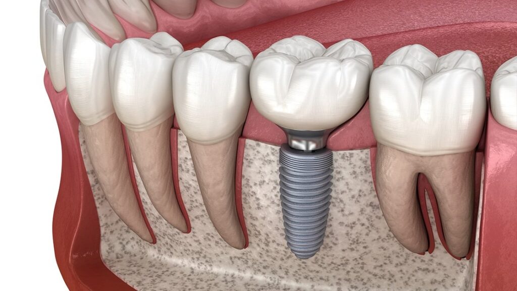 ایمپلنت دندان چقدر طول میکشد ؟