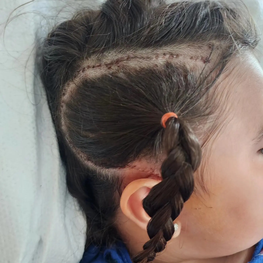 پزشکان در یک جراحی ۱۰ ساعته نیمی از مغز دختر ۶ ساله را خاموش کردند