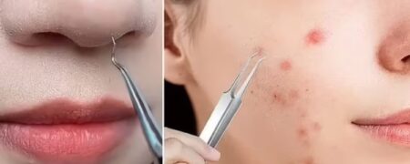 باورنکردنی اما رضایت‌بخش؛ موچین مخصوص جوش های سر سیاه + ویدیو