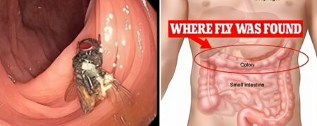 پیدا شدن یک مگس زنده و سالم درون روده های یک مرد آمریکایی!