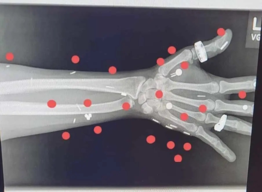 زن شعبده باز رکورددار بیشترین ایمپلنت تکنولوژیکی در بدن + ویدئو