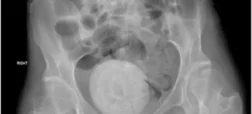 شوکه شدن پزشکان از کشف «سنگ واژن» بسیار بزرگ در لگن زن ۲۷ ساله