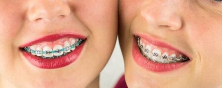 قیمت ارتودنسی چهار دندان جلو