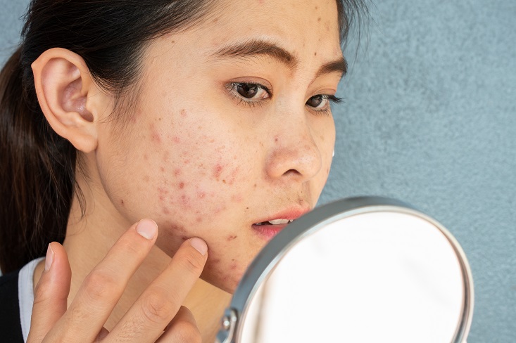 3 what age does acne go away feature image