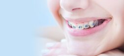 هزینه ارتودنسی دندان در سال ۱۴۰۳ چقدر است؟
